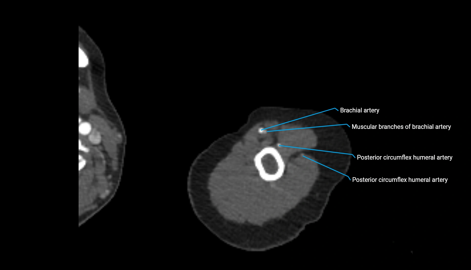 CTA upper limb axial cross sectional anatomy labelled image 300 (1).webp
